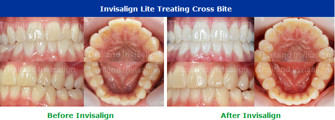 Invisalign Cases Thailand