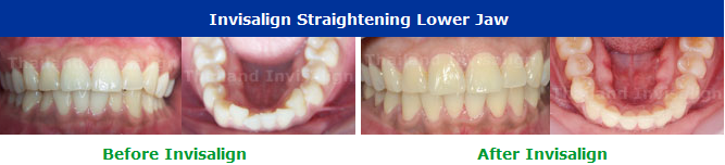 Invisalign Cases Thailand