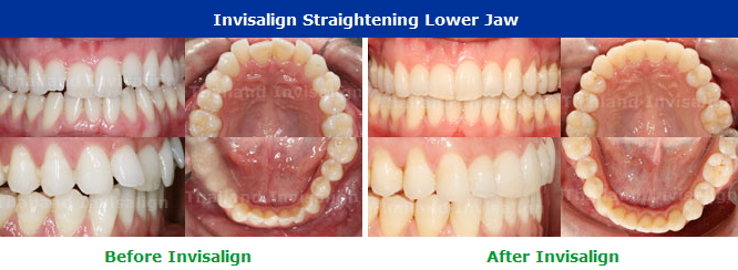 Invisalign Cases Thailand